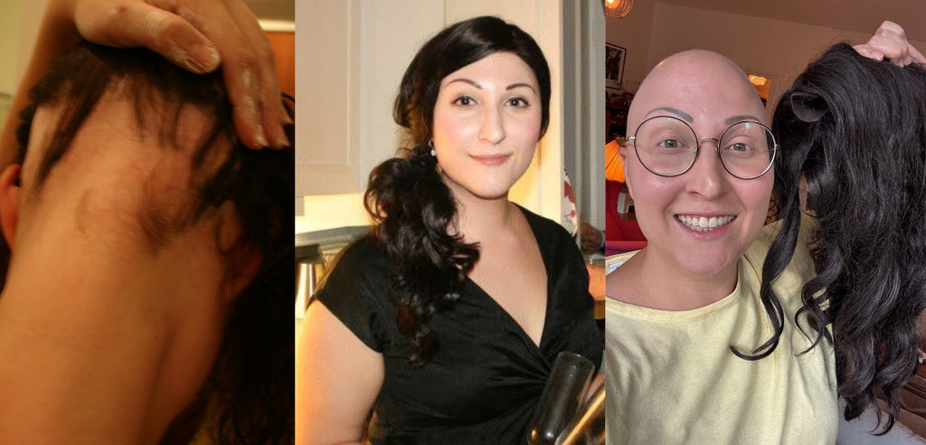Tre bilder av Lilian Botvaldes alopecia. En med kal nacke, en med peruk och en med skalligt huvud - leende mot kameran